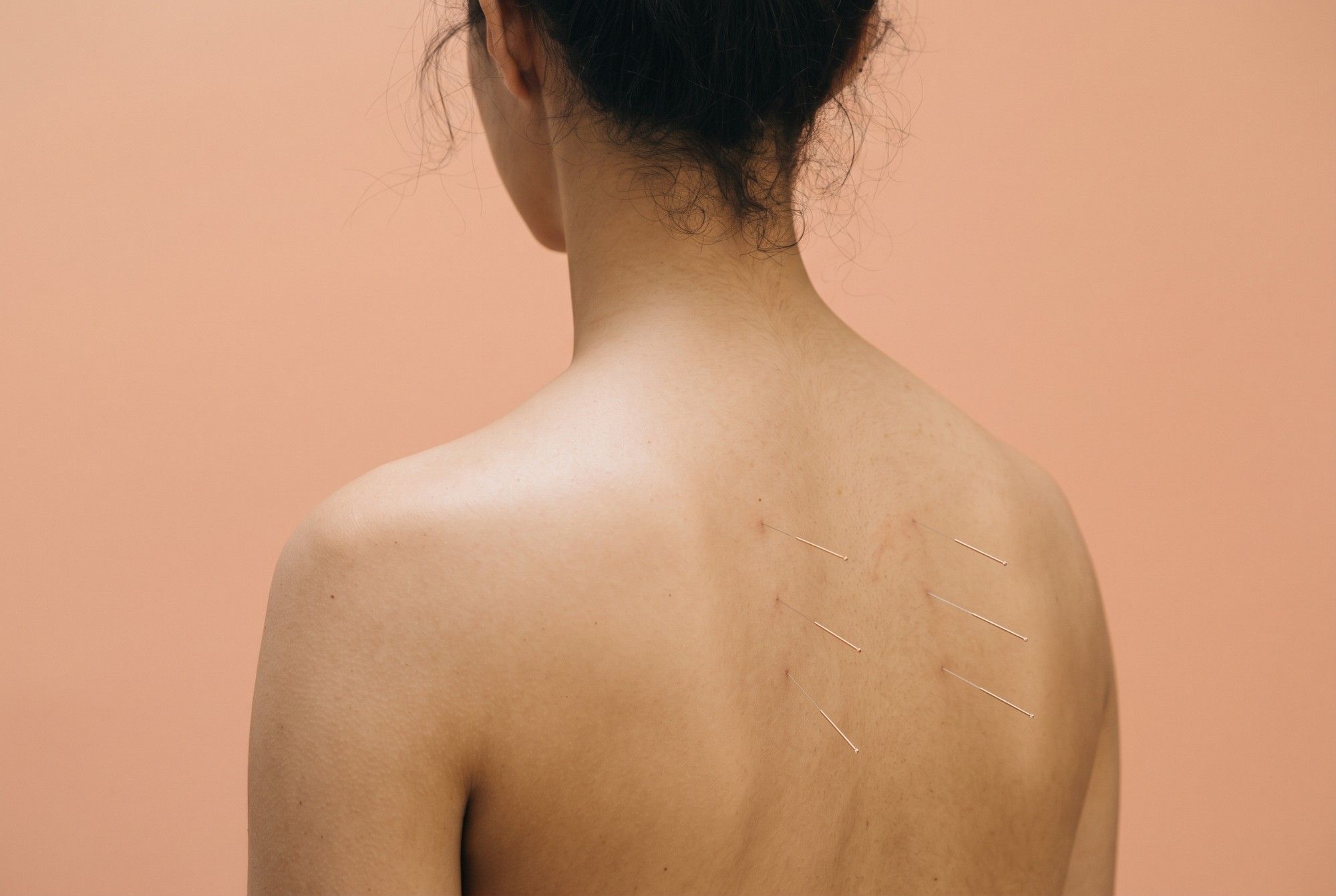 Acupunctuur treatment