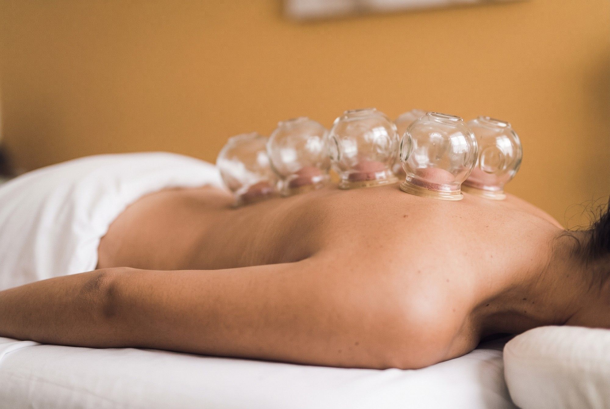 Acupunctuur + Cupping treatment